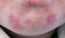 аллергия фото на лице