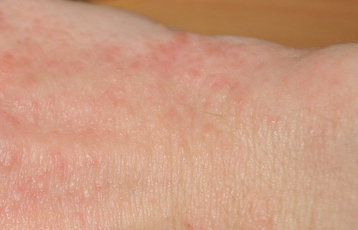 Как проявляется аллергия на моющие средства у взрослых и детей?